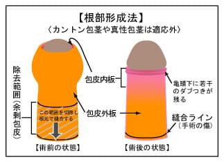 根部形成法による包茎手術 様々な包茎の手術や治療の方法 東京 大阪