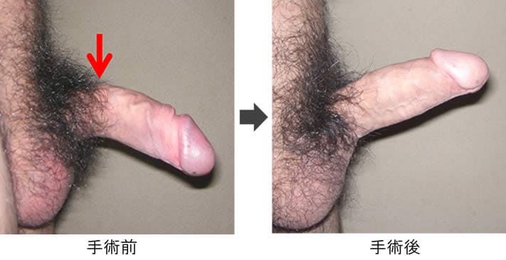 屈曲ペニス湾曲ペニスの症例写真症例№04-1