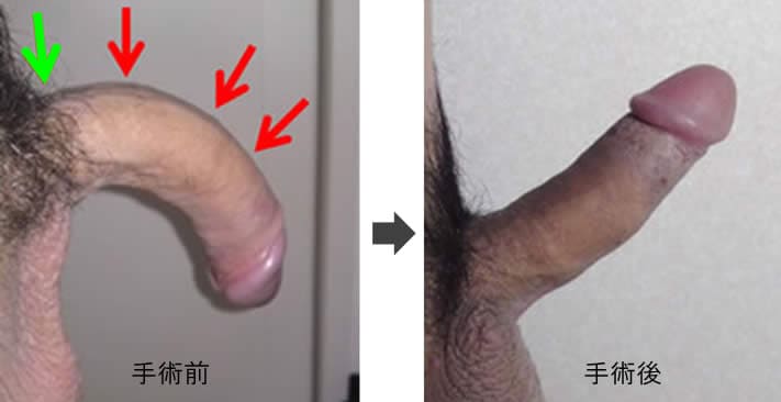 屈曲ペニス湾曲ペニスの症例写真症例№06
