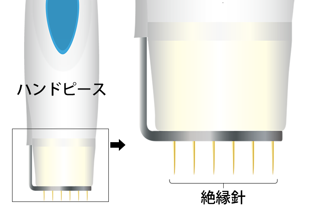 ビューホット治療のしくみ